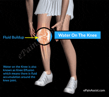 how do we define water on the knee or knee effusion? GIF by ePainAssist