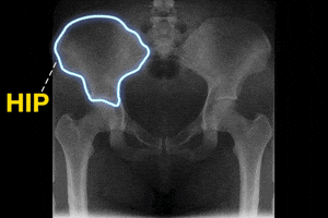 Digital art gif. The hip bones of a human torso X ray light up one at a time, outlined in neon blue. Yellow text appears, "Hip, hip, Hooray!" with the word Hooray filling the frame and falling down the screen.