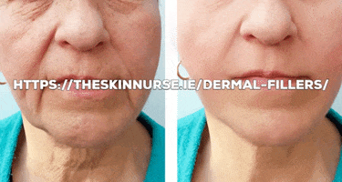 Dermal Fillers GIF
