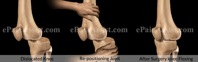 causes of knee dislocation GIF by ePainAssist