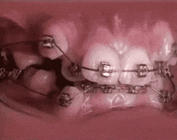 lapse braces GIF