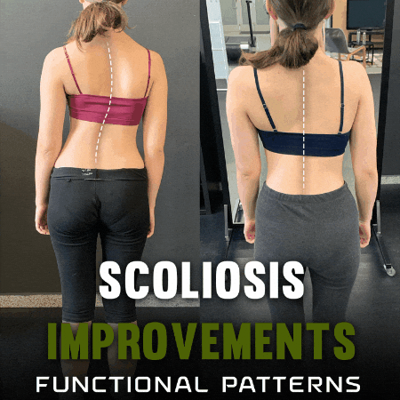 Scoliosis GIF by functionalpatterns
