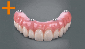 Dental Implants GIF