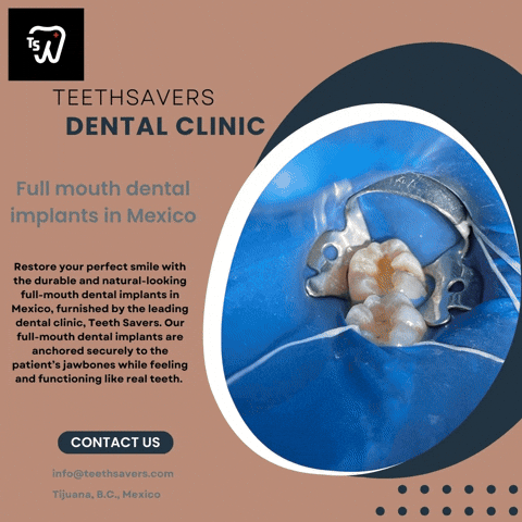 Full Mouth Dental Implants In Mexico GIF
