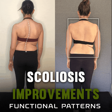Scoliosis GIF by functionalpatterns