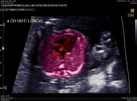 Fetus GIFs - Find & Share on GIPHY