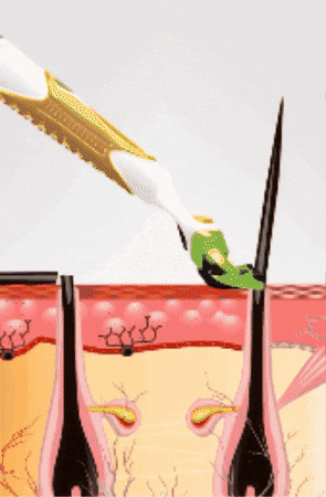 Lazer Epilasyon GIF by Buz Lazer  - Epilasyonda Başka Boyut