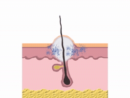 How Acne Appears GIF