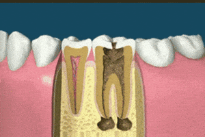 canal root GIF
