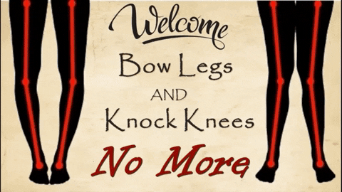 Bowlegsnomore giphyupload bow legs knock knee bow legs no more GIF