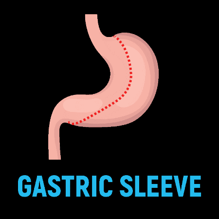 Gastricsleeve GIF by Medproper Health Tourism
