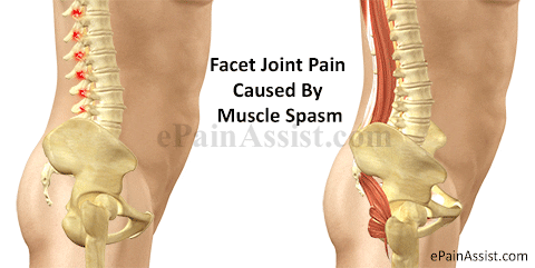 causes of facet joint GIF by ePainAssist