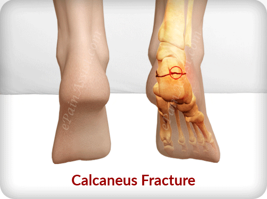 what is calcaneus fracture or broken heel? GIF by ePainAssist