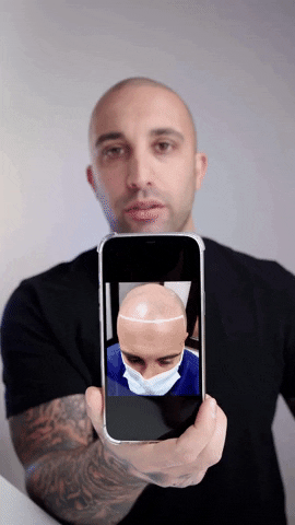 gerowhairink giphygifmaker smp hairloss hairline GIF