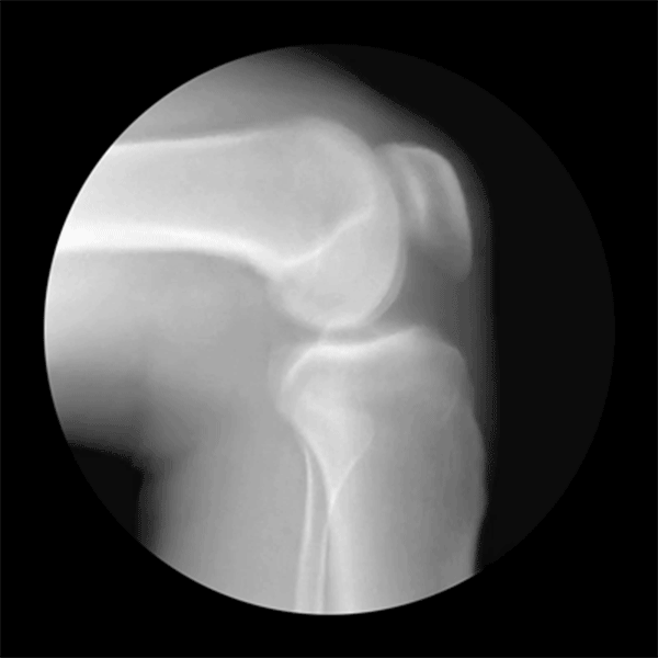 fisioterapia joelho GIF