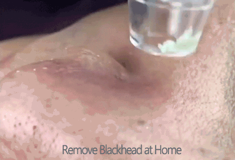 Anatomylaborg giphyupload blackhead remover GIF