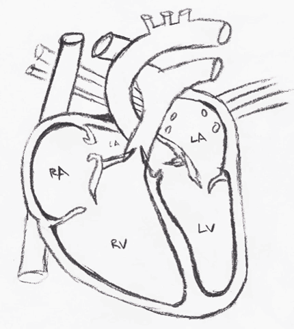 bloodflow atrial septal defect GIF