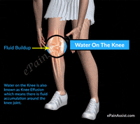 how do we define water on the knee or knee effusion? GIF by ePainAssist