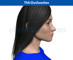 temporomandibular joint disorder tmj dysfunction GIF by ePainAssist